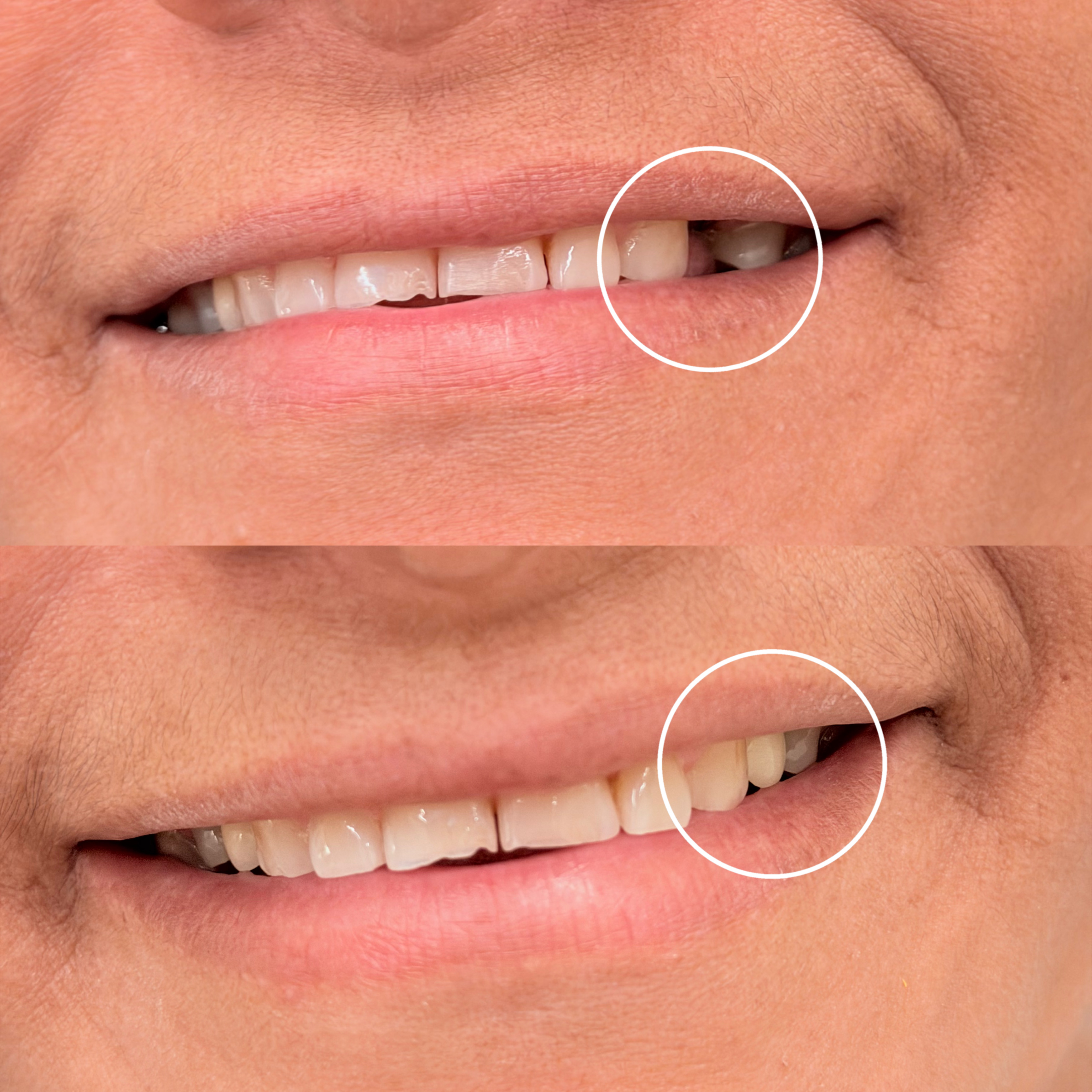 Antes e depois de tratamento dentário
